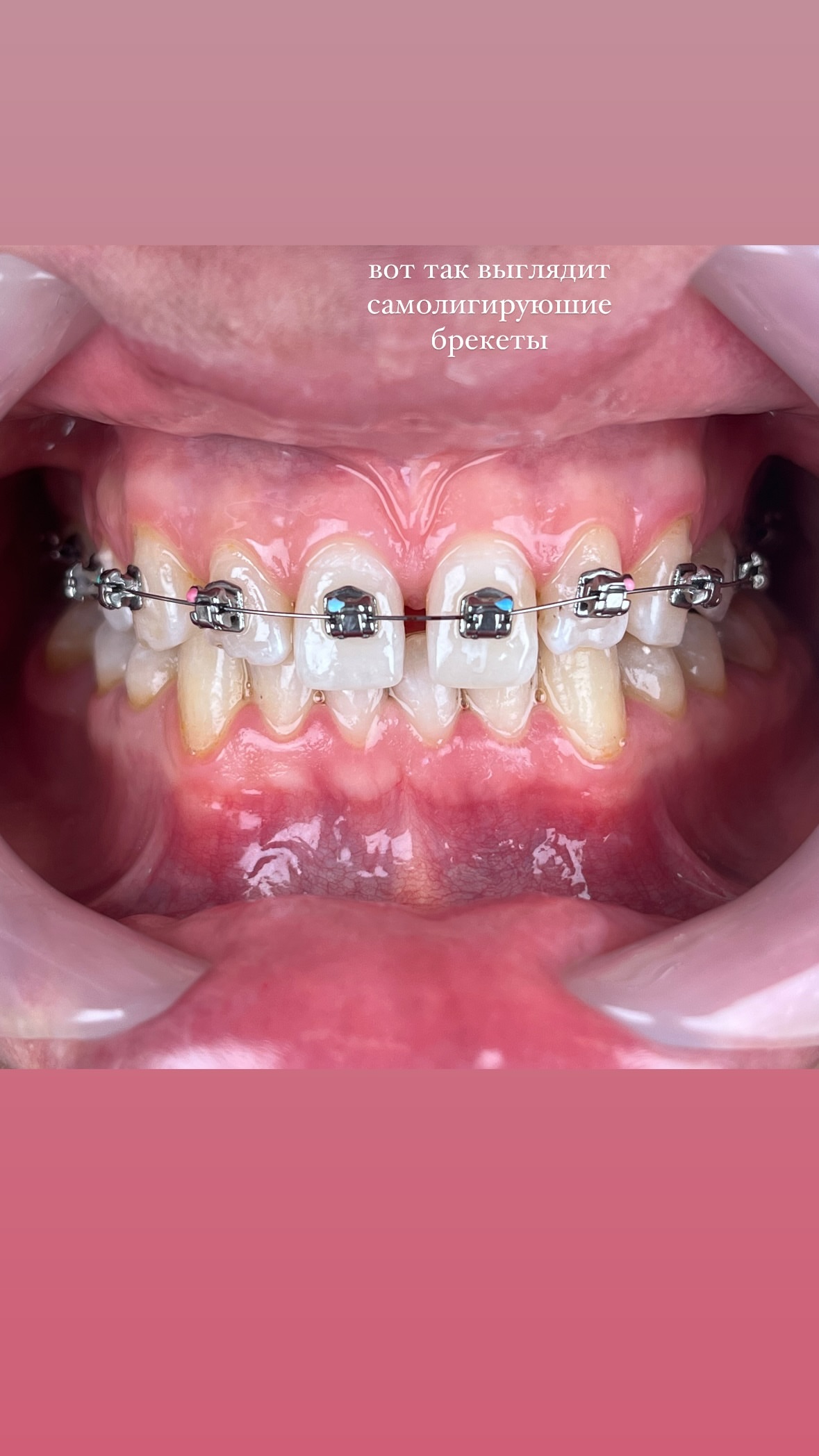 Брекеты — результат 1