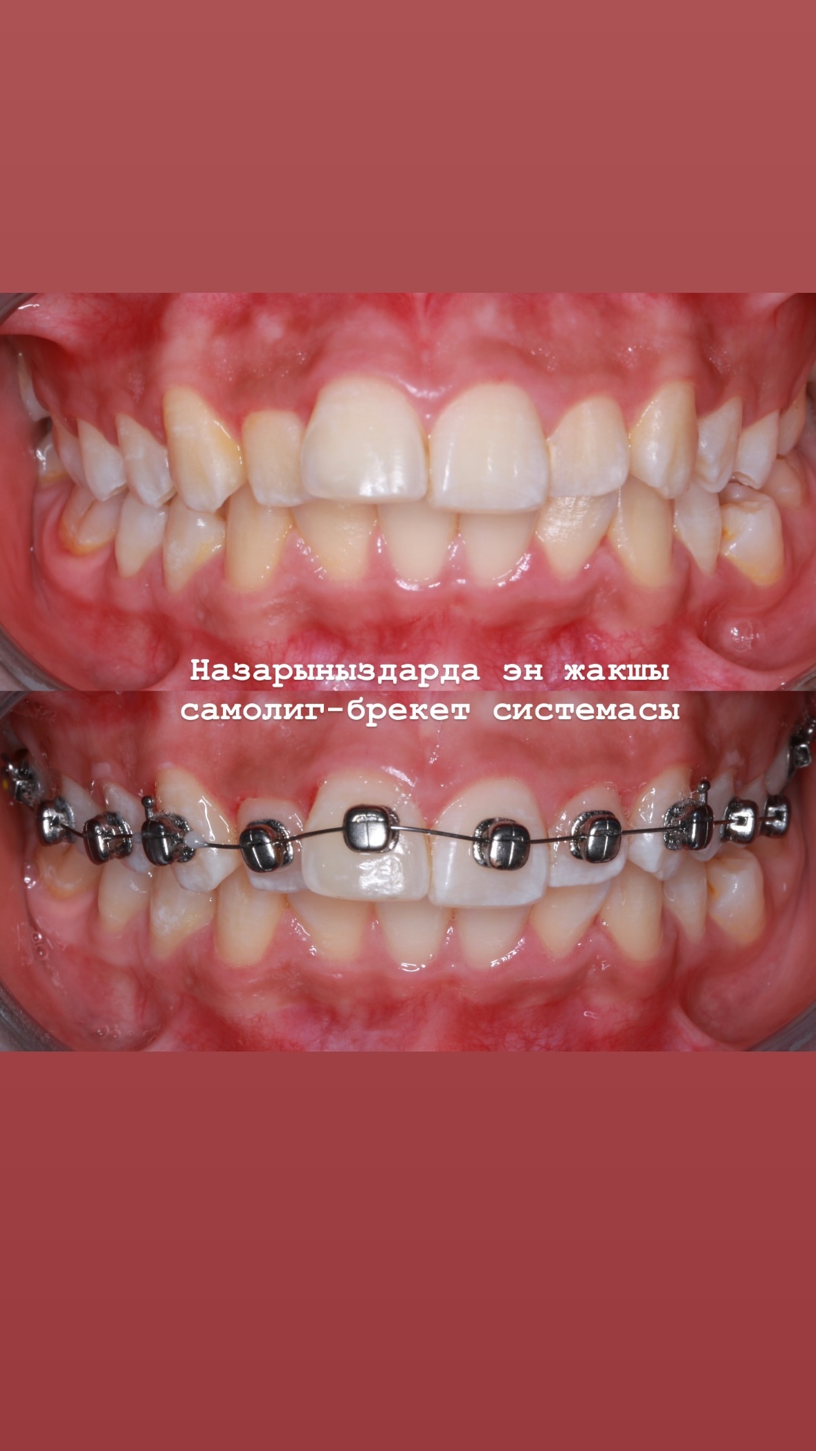 Брекеты — результат 2