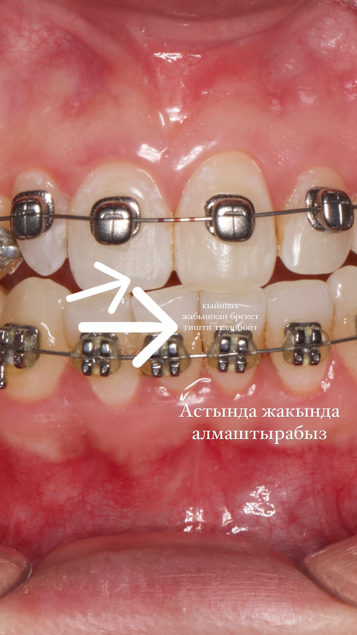 Брекеты — результат 5