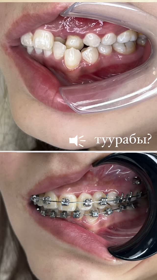 Брекеты — результат 6