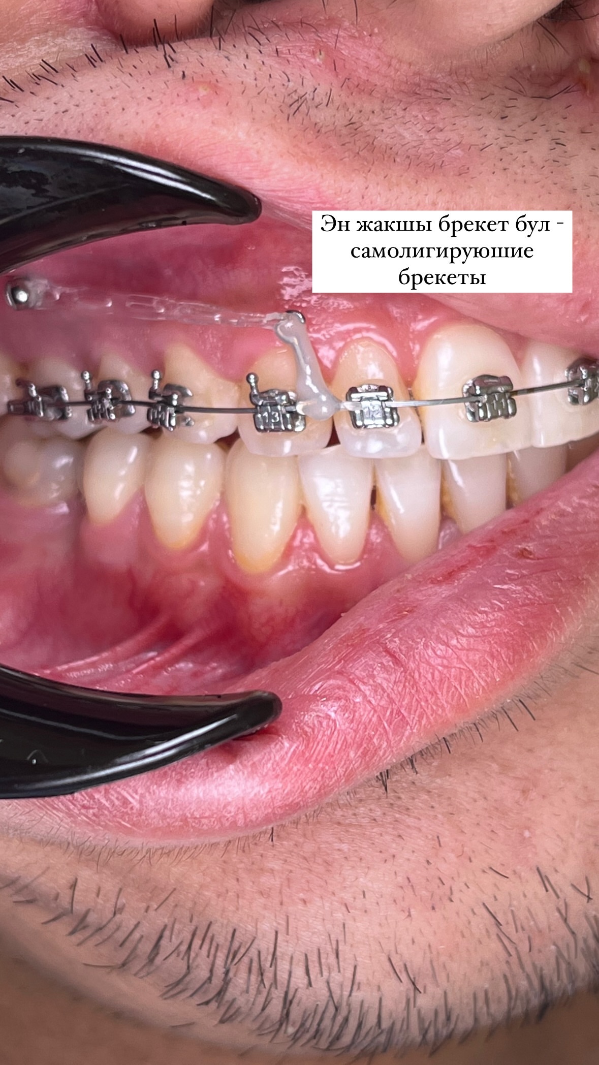 Брекеты — результат