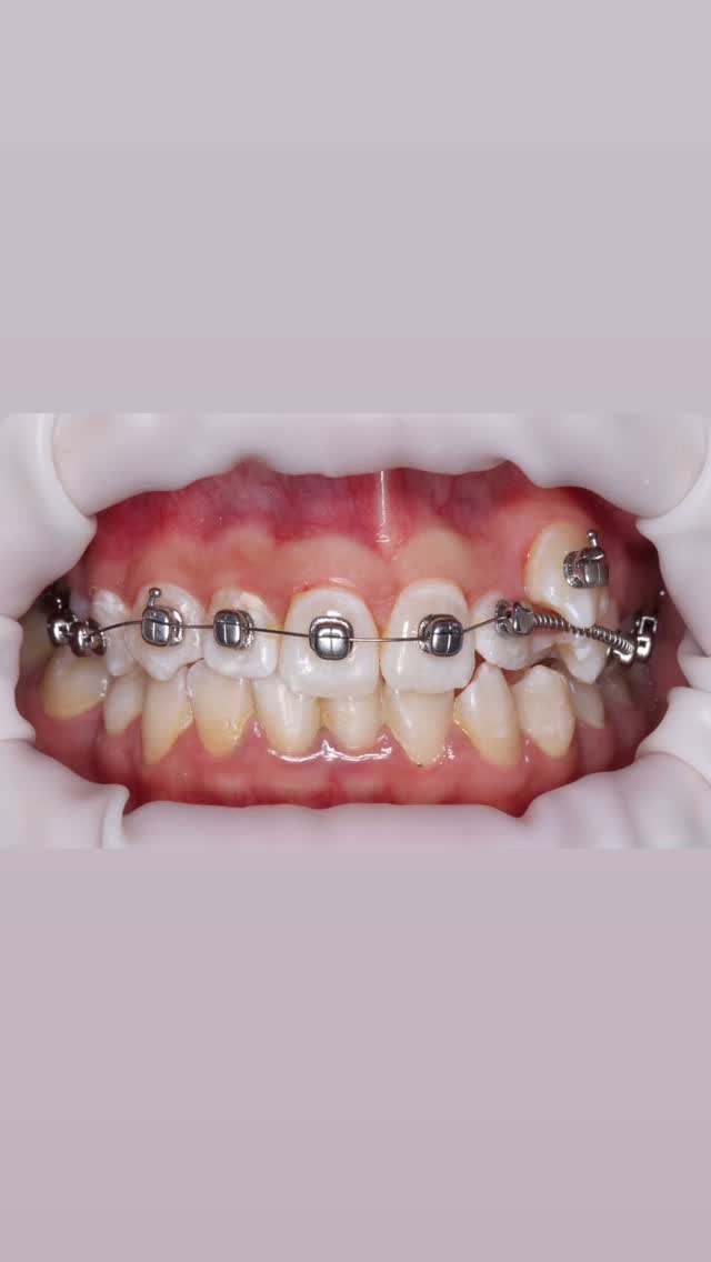 Результат брекеты