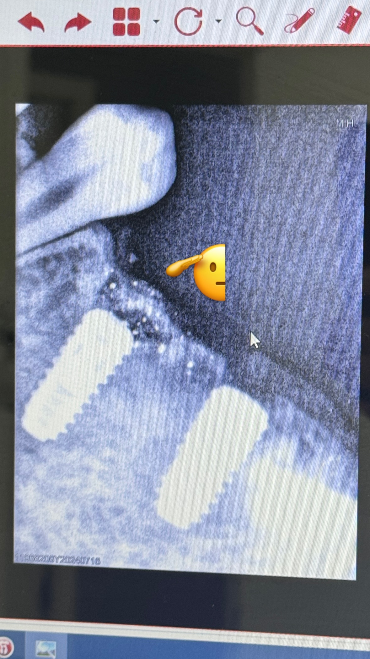 Имплантация — результат 2