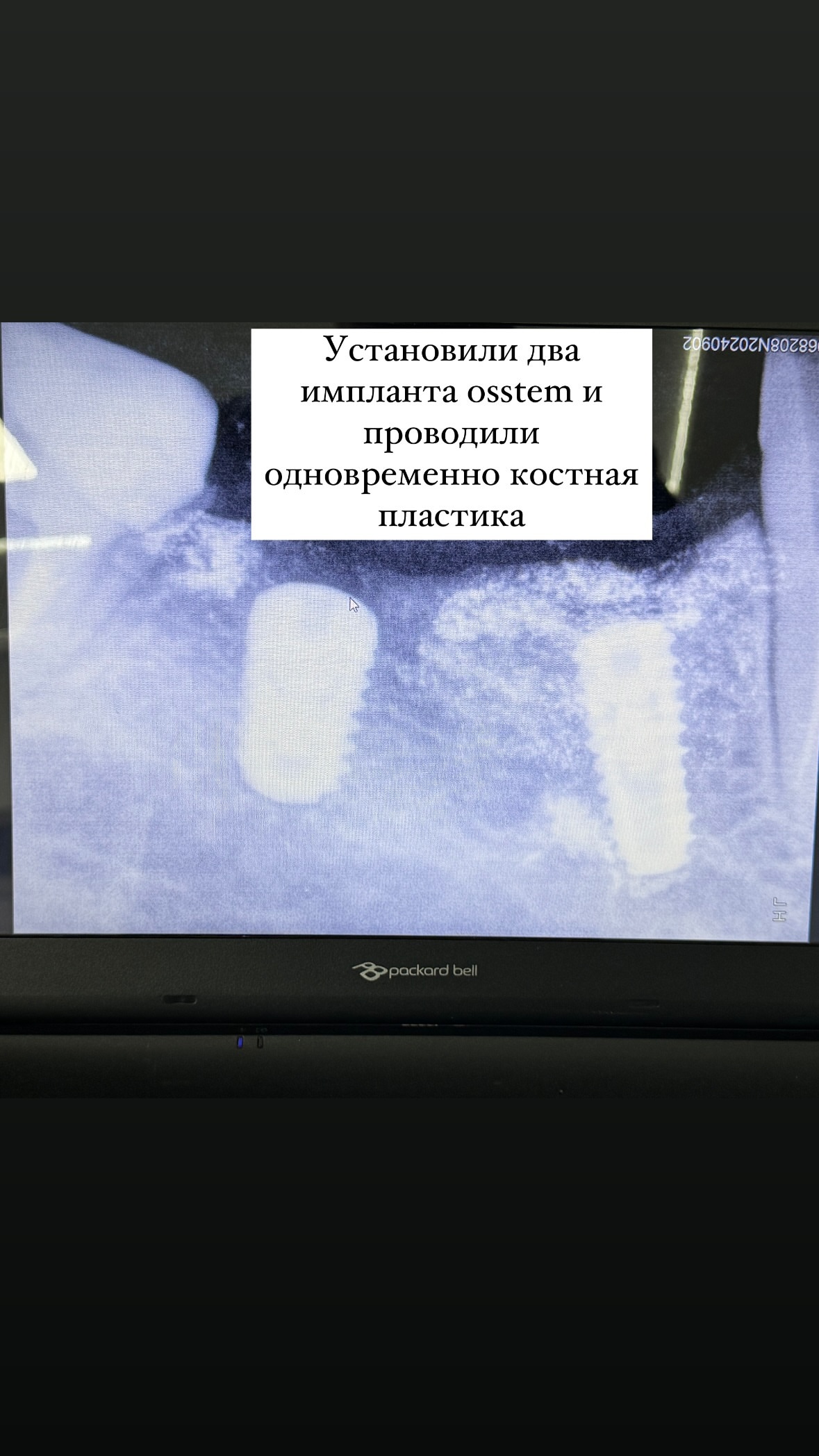 Имплантация — результат 4