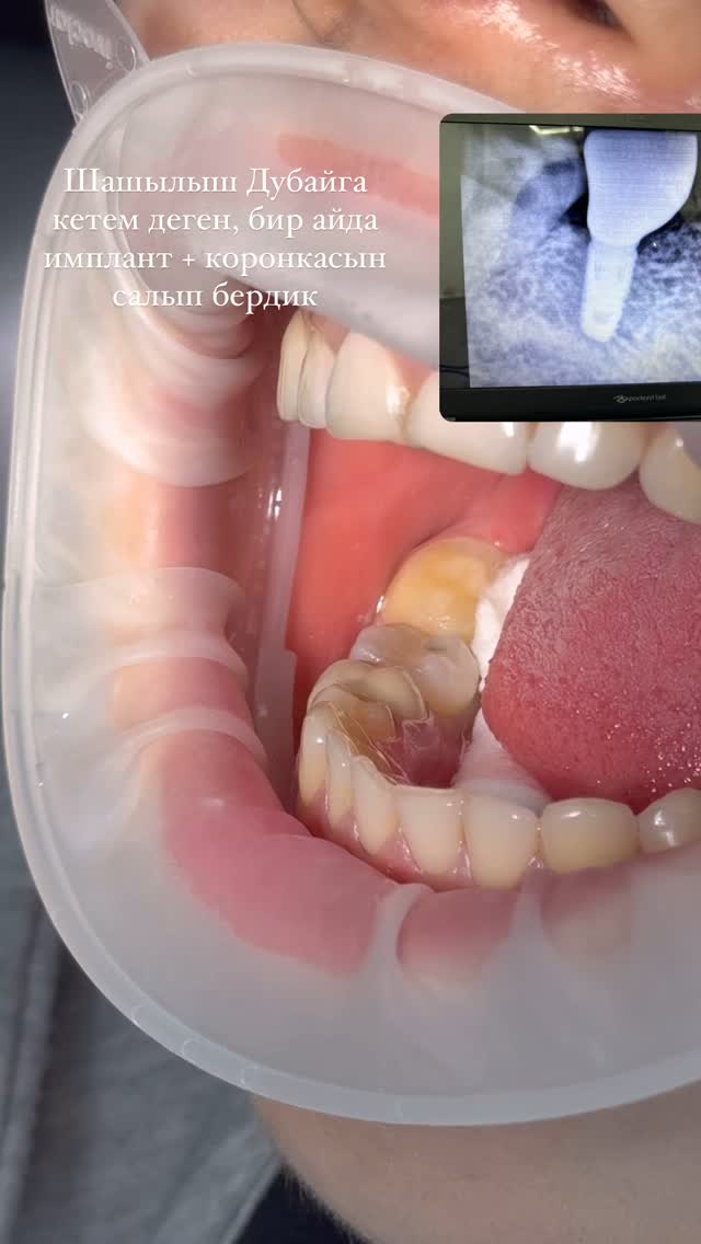 Имплантация — результат 6