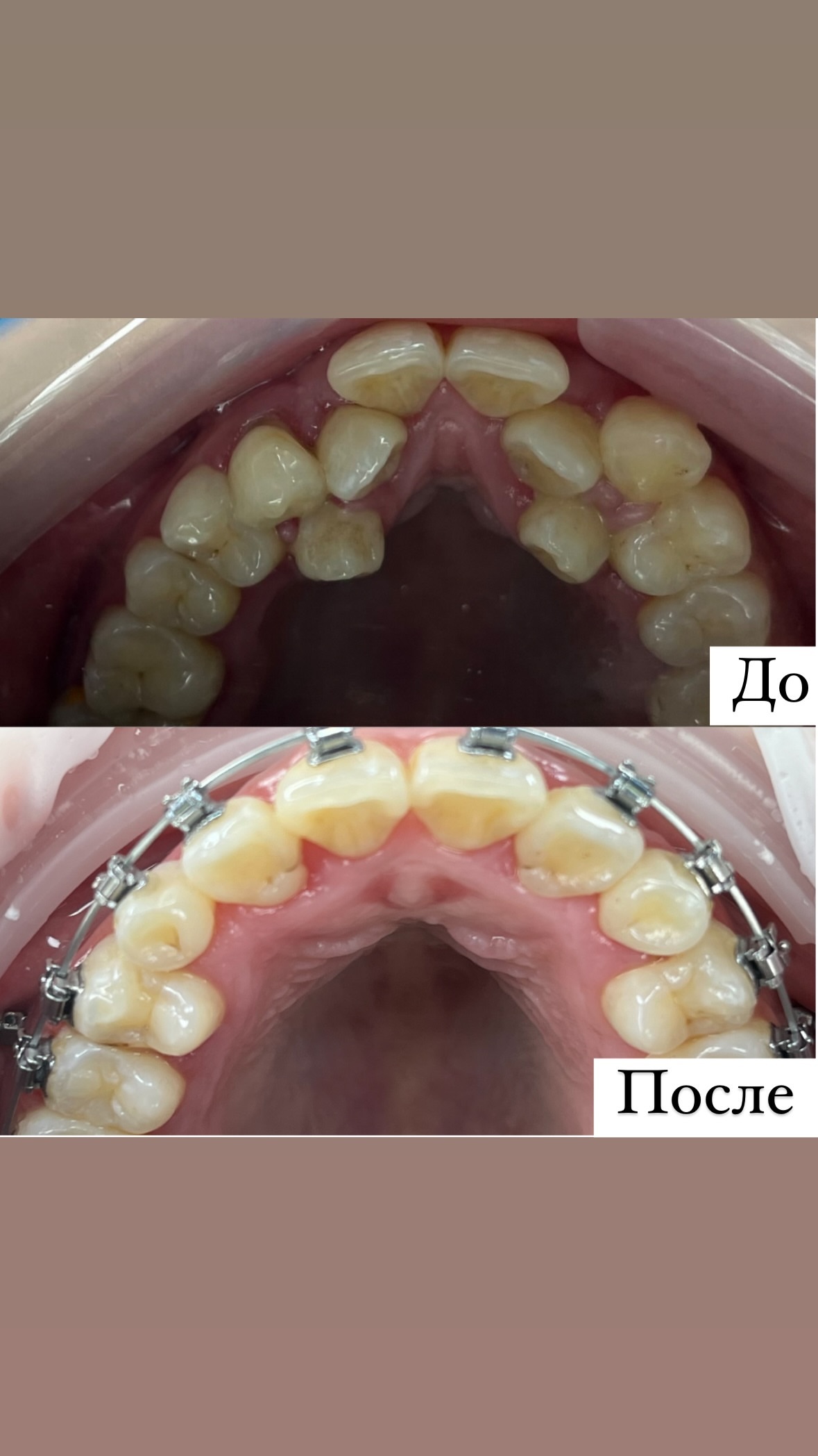 Реставрация зубов