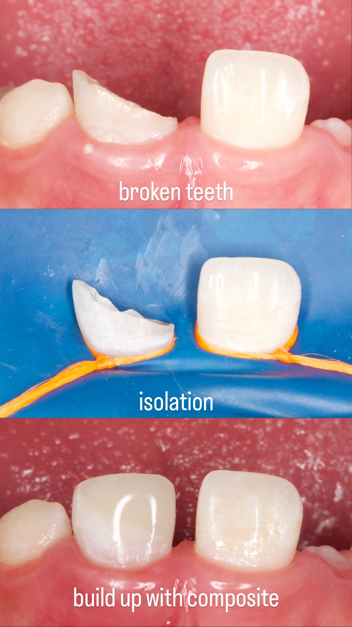 Циркониевые коронки