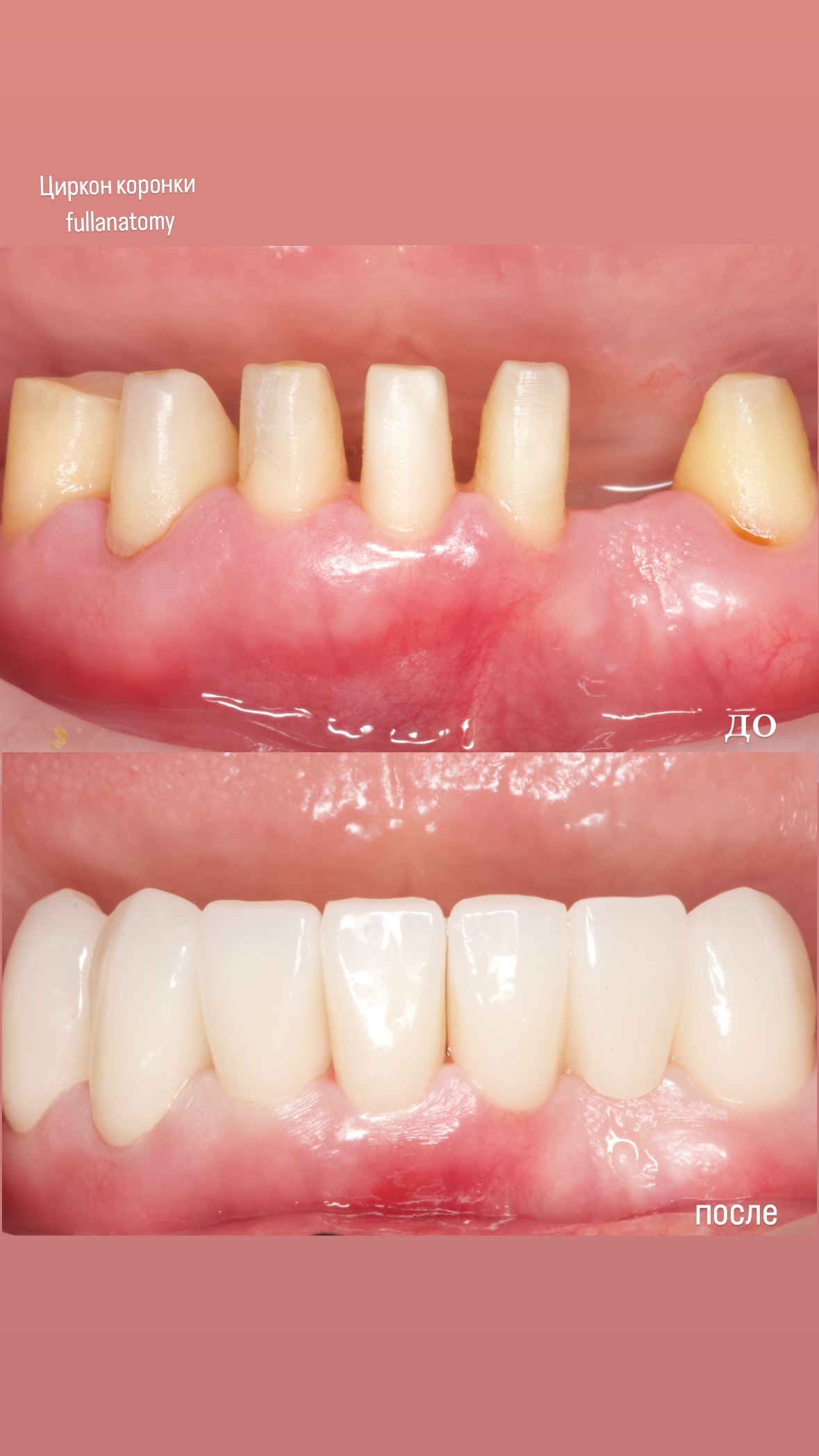 Циркониевые коронки